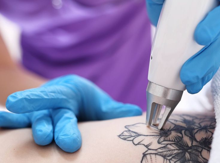 Tattoo Removal in Dubai: Expert Tips