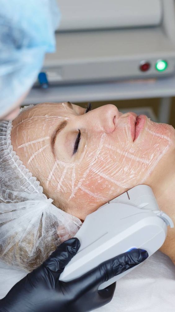 Laser Hair Removal for Dark Hair, Light Skin