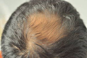 Dubai's Secret for Thicker Hair: Finasteride