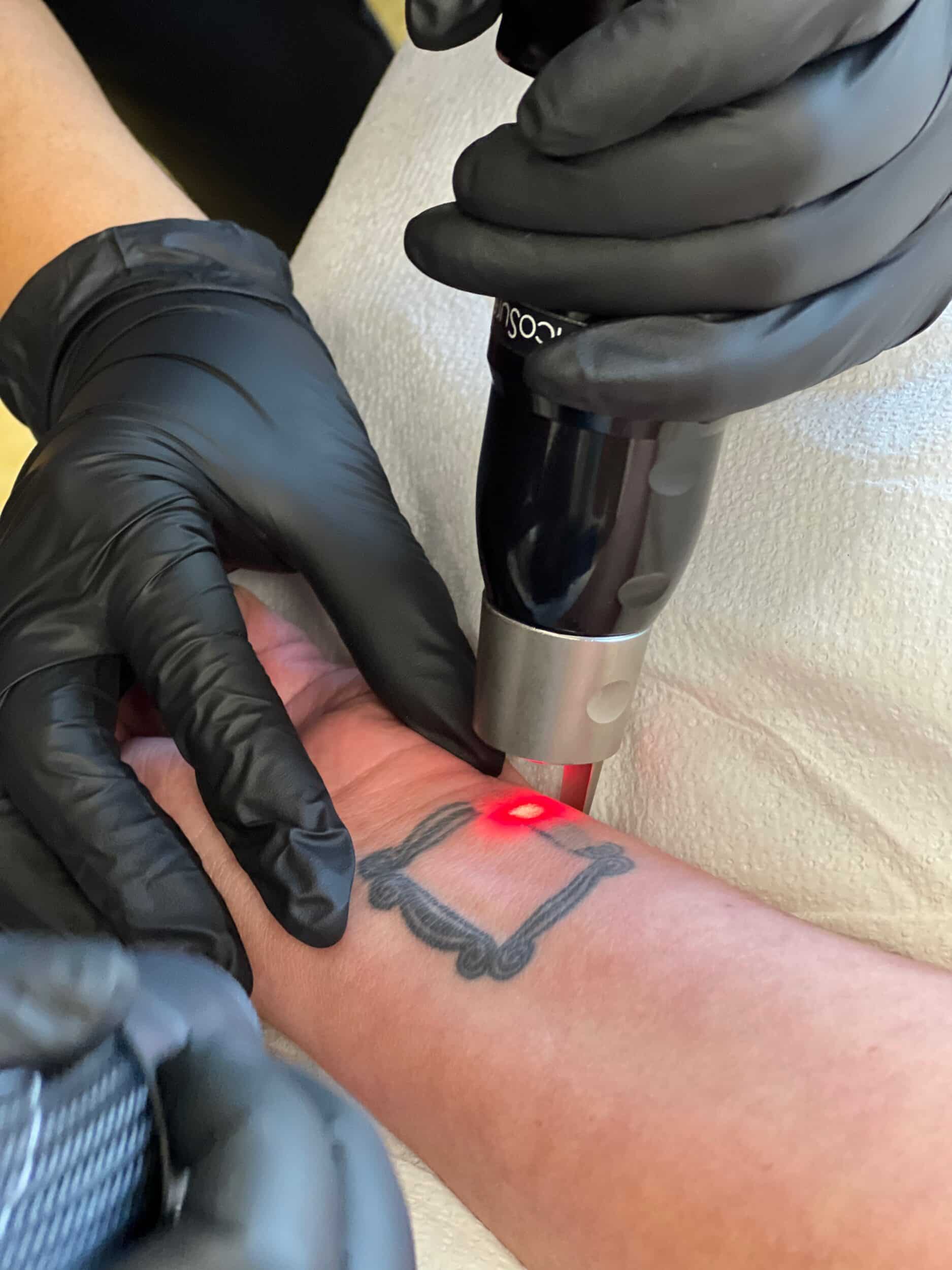 Laser Tattoo Removal: Painless Tattoo Removal Process