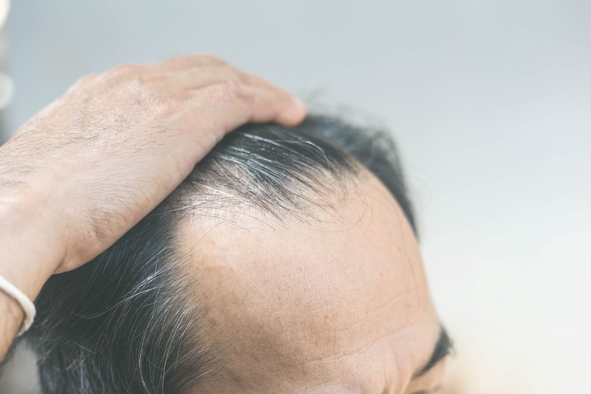 Hair Loss Solution: FUE Hair Transplants