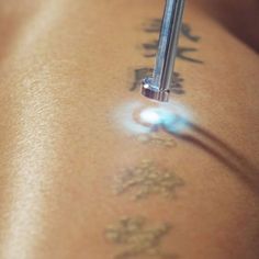 Tattoo Removal in Dubai: All You Need to Know