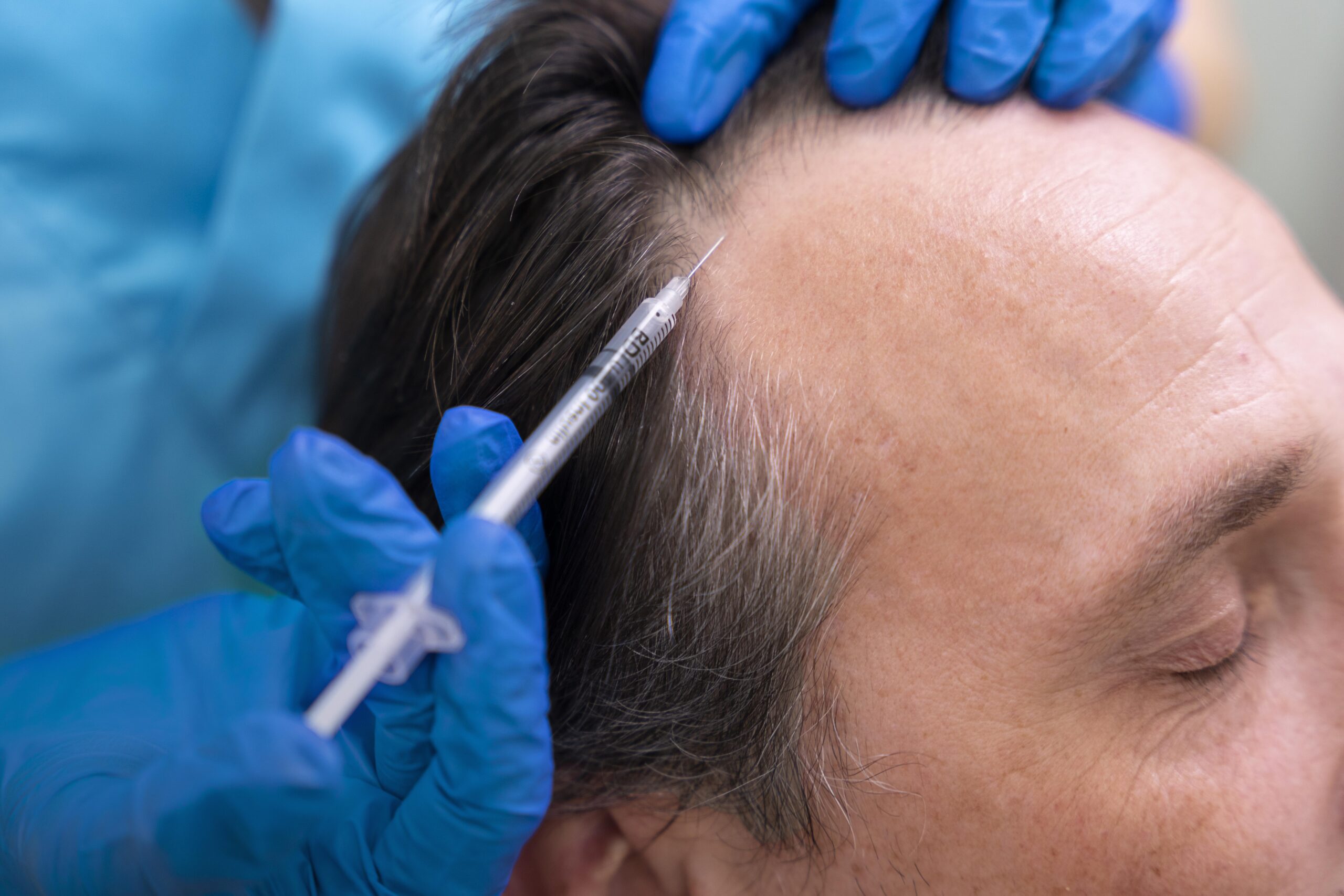 FUE Hair Transplants: The Smart Choice for Hair Regrowth