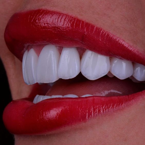 Ready to Smile Brighter?  Composite Veneers Await