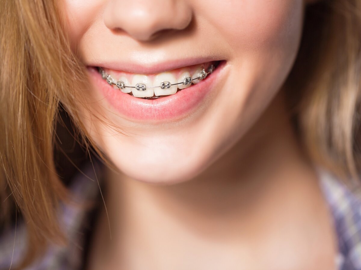 The Power of Metal Braces for Your Teeth