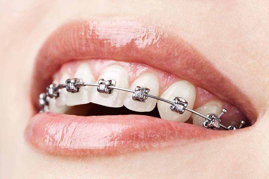 Why Metal Braces Are Worth the Investment