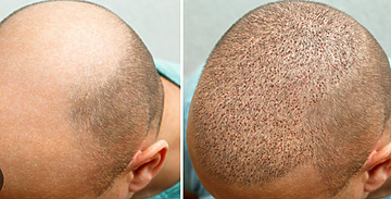 FUE Hair Transplant: Quick Recovery Time