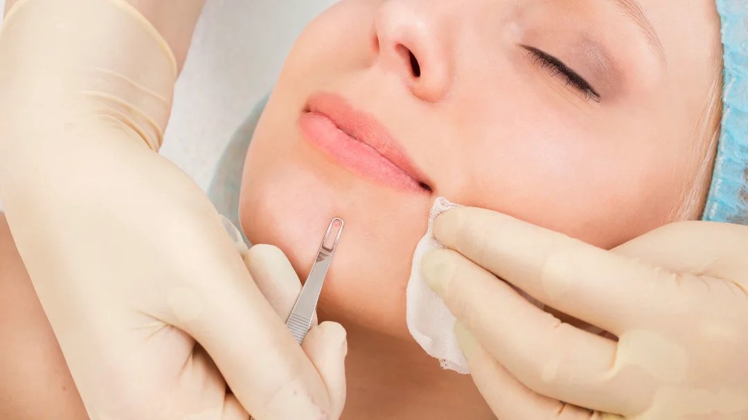 What to Expect from a Deep Cleansing Facial with Extraction in Dubai A Comprehensive Overview