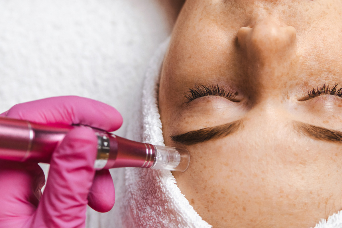 Revitalize Your Skin with Microneedling Sessions