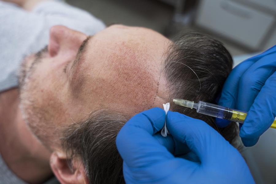 FUE Hair Transplants: Unlock Your Hair's Potential