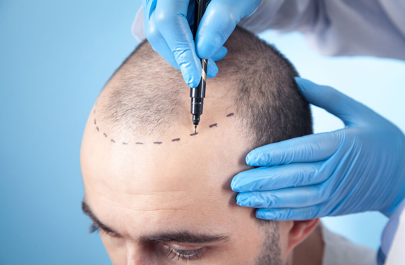 FUE Hair Transplant: Fast Recovery Time