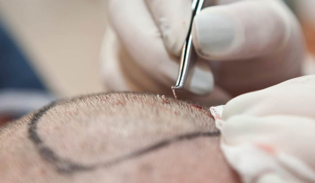 Hair Transplant Cost: What’s the Breakdown?