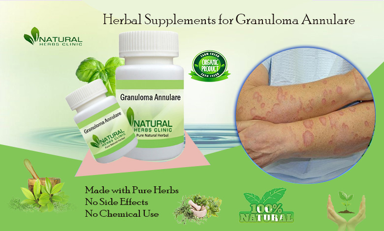 Effective Granuloma Annulare Remedies You Can Try Right Now!