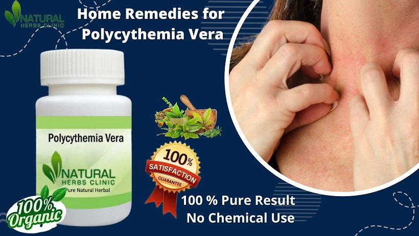 Natural Remedies for Polycythemia Vera Revealed: Say Goodbye to Symptoms