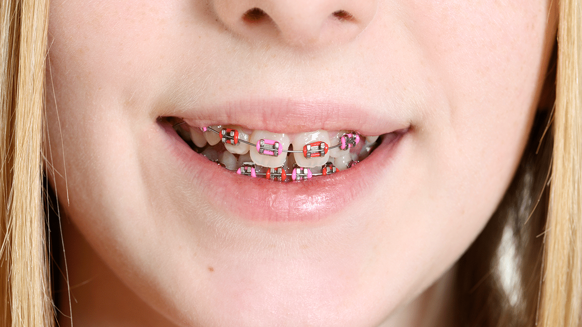 Embrace Your Smile Journey with Metal Braces