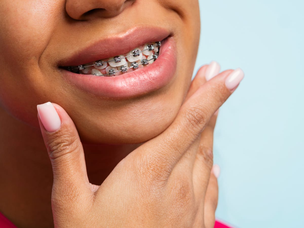 Metal Braces: The Ultimate Guide for Patients