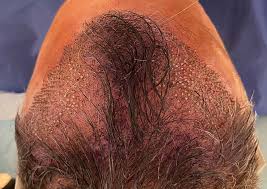 Hair Transplant Cost: Making Sense of the Numbers