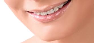 Your Perfect Smile Begins with Dental Braces