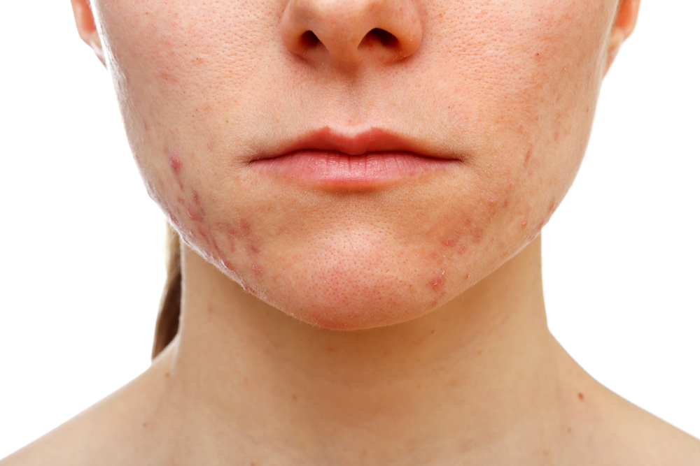 Laser Acne Treatment: Precision for Flawless Complexion