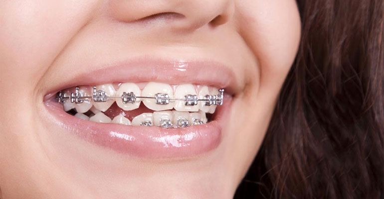 Dental Braces Health Your Route to Straighter Teeth