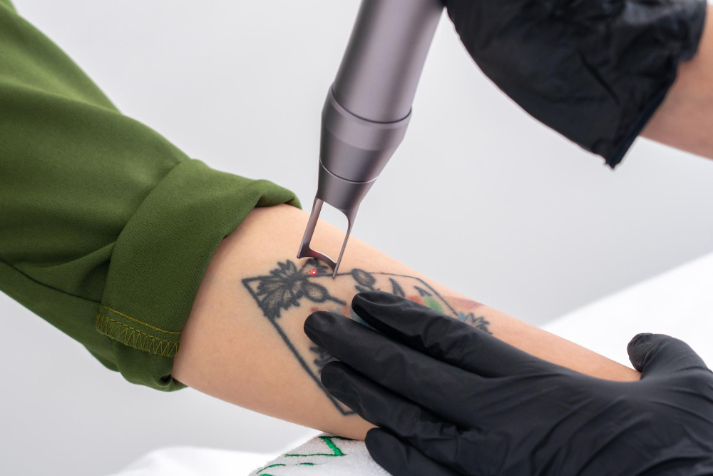 Laser Tattoo Removal: Transform Your Skin Today