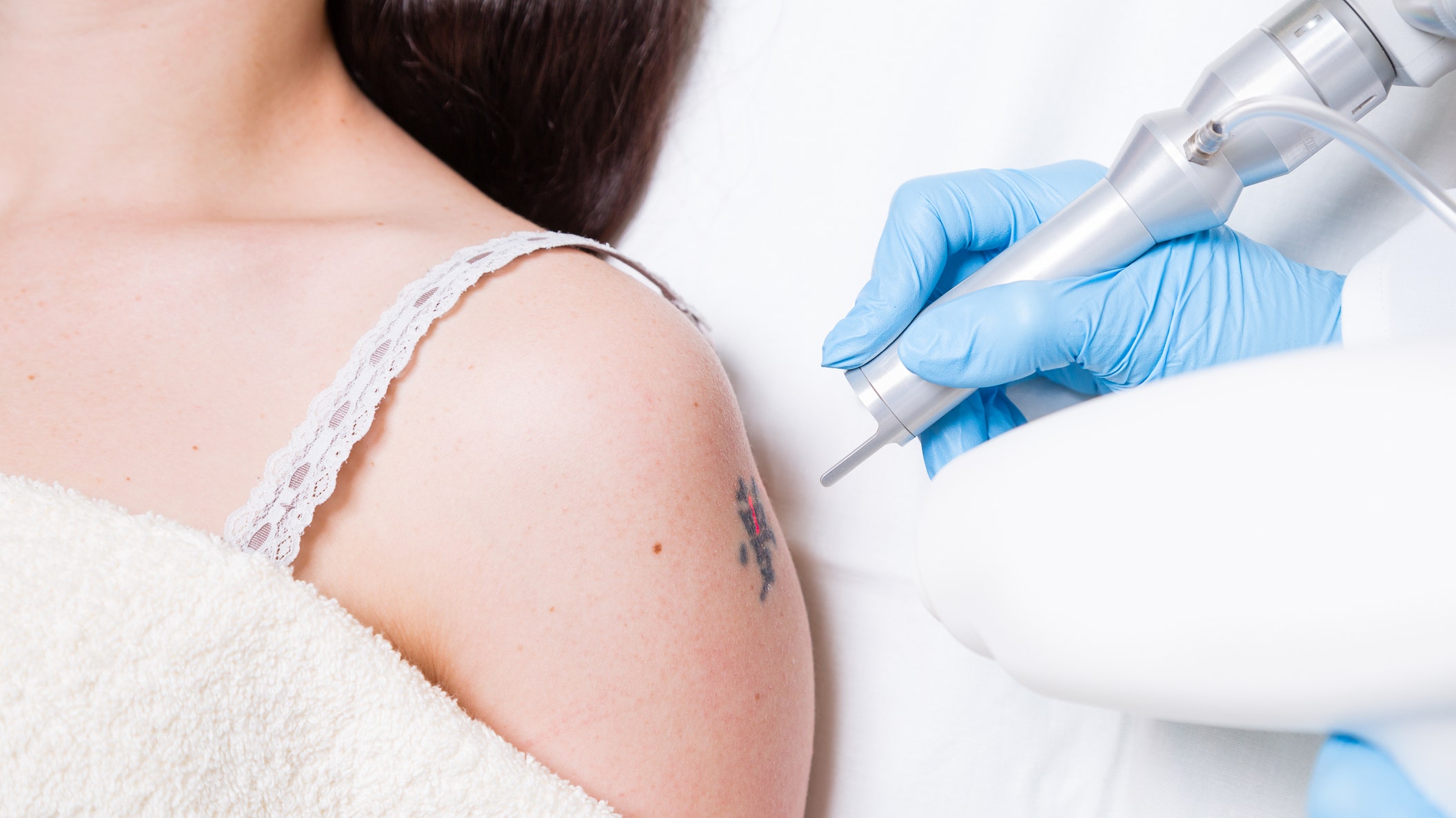 The Role of Skilled Professionals in Laser Tattoo Removal in Dubai