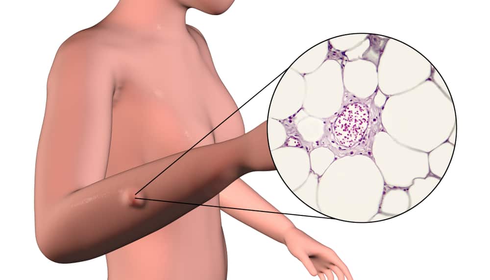 Lipoma Treatment: Understanding the Recovery Process