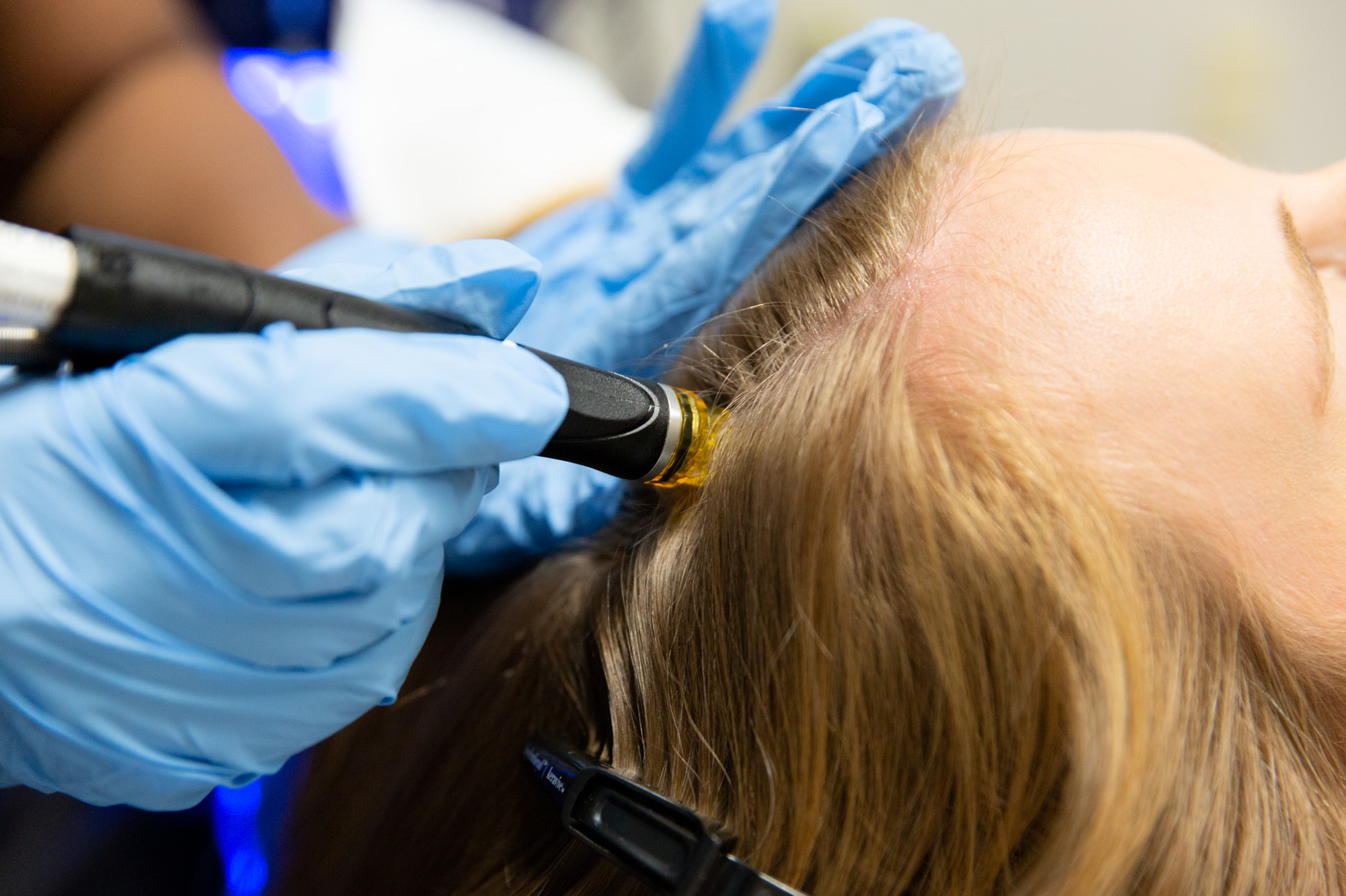 Enhance Your Hair Journey with Hydrafacial Scalp Treatment