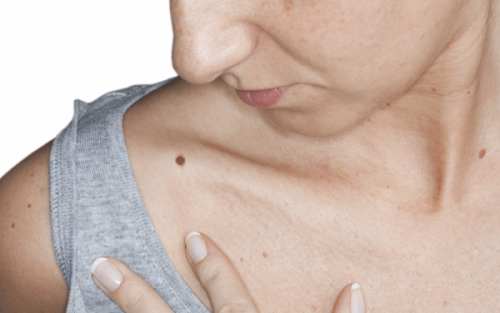 The Role of Dermatology in Mole Removal in Dubai