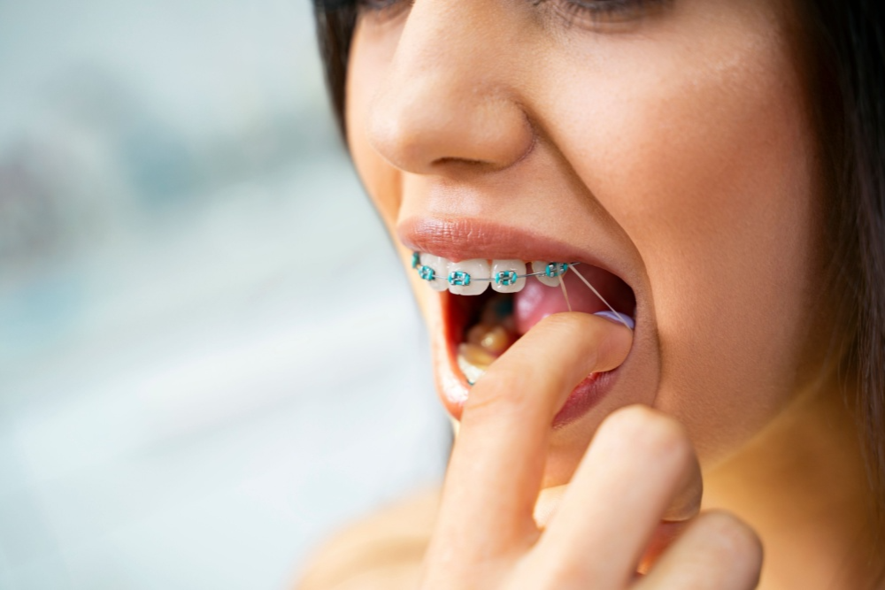 Why Metal Braces Are the Gold Standard