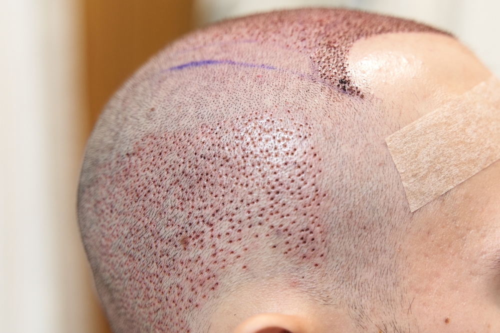 Advantages of Choosing FUE Hair Transplant