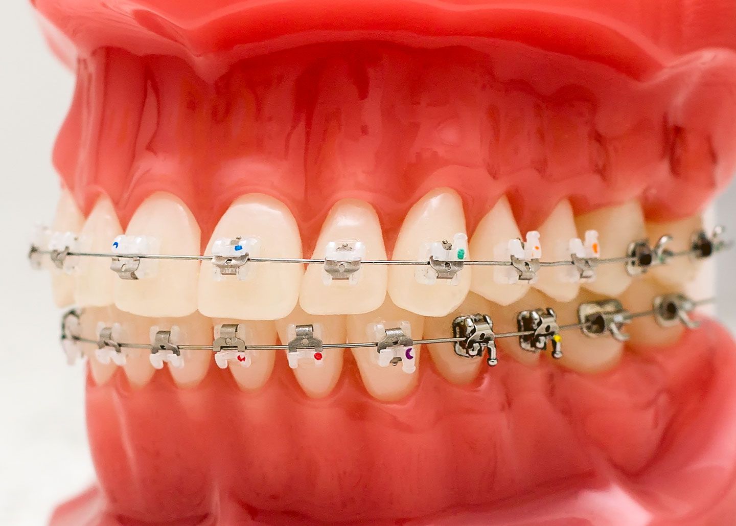 The Power of Metal Braces for Perfect Teeth