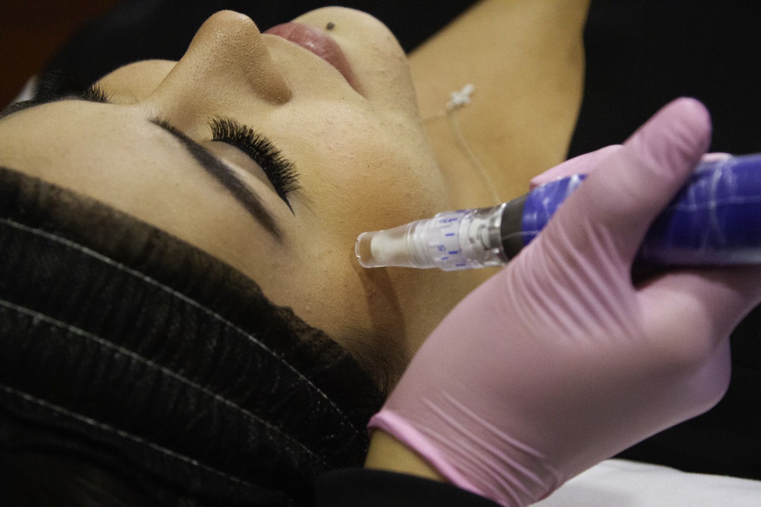 Microneedling: A Fresh Approach to Skin Care