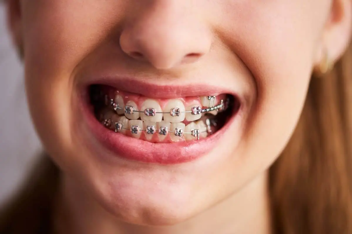 Metal Braces: Strongest Option for Teeth Alignment