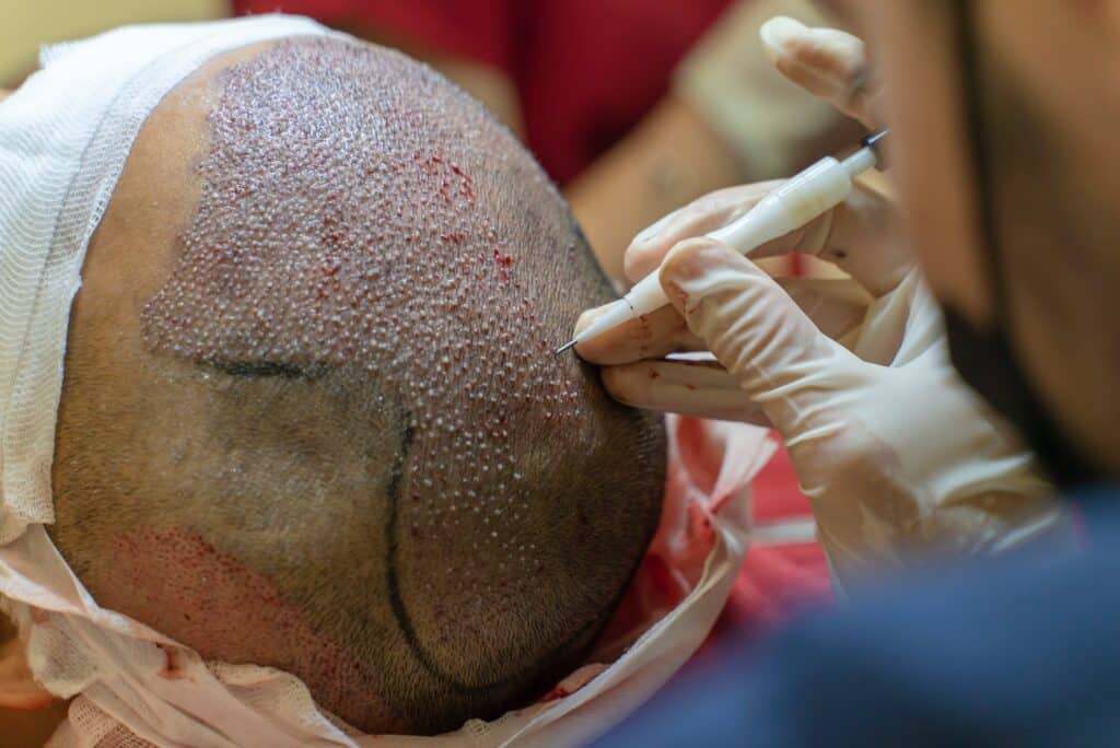 FUE Hair Transplant: A Solution for Thinning Hair