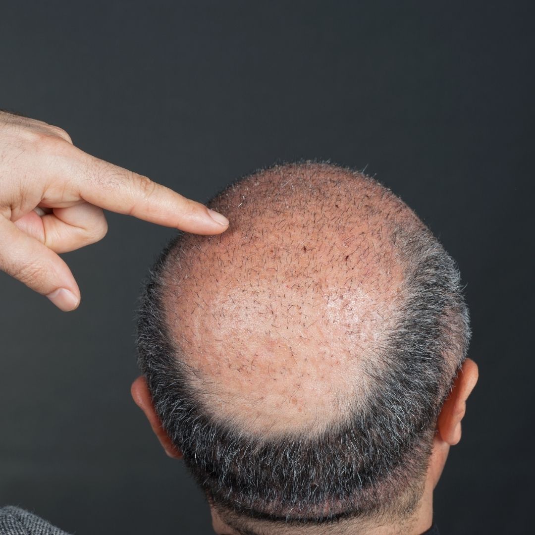 Natural-Looking Hair: FUE Hair Transplant