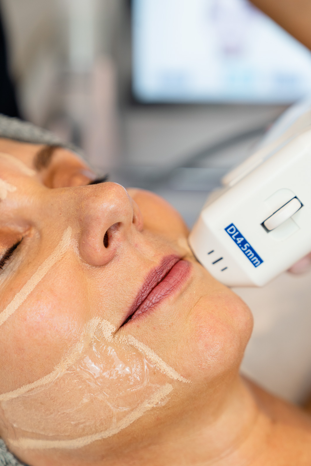 HIFU Treatment Innovations for Ageless Beauty