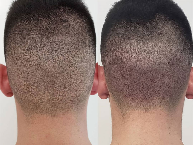 FUE Hair Transplant: Minimal Scarring