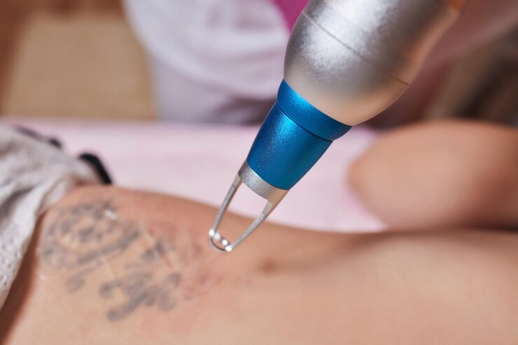 Laser Tattoo Removal: Smooth Results