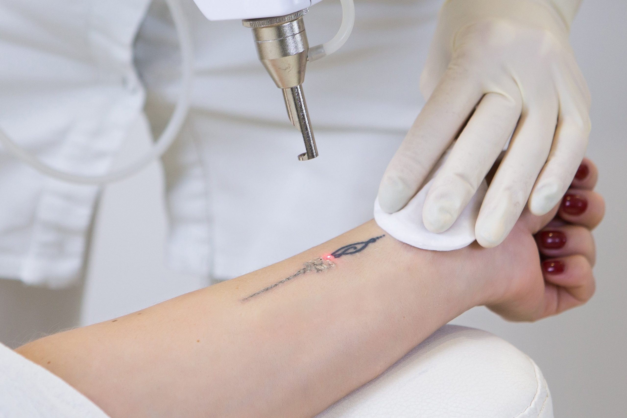 Top Trends in Laser Tattoo Removal Technology in Duba