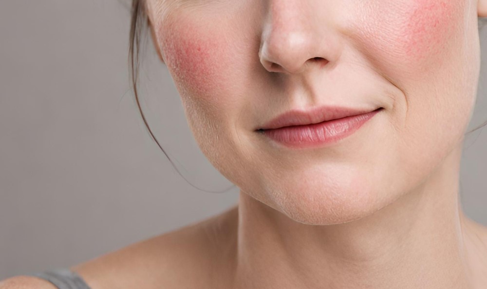 Innovative Rosacea Treatments Now Available in Dubai