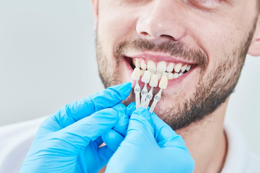 Composite Veneers  An Affordable Smile Makeover Option in Dubai