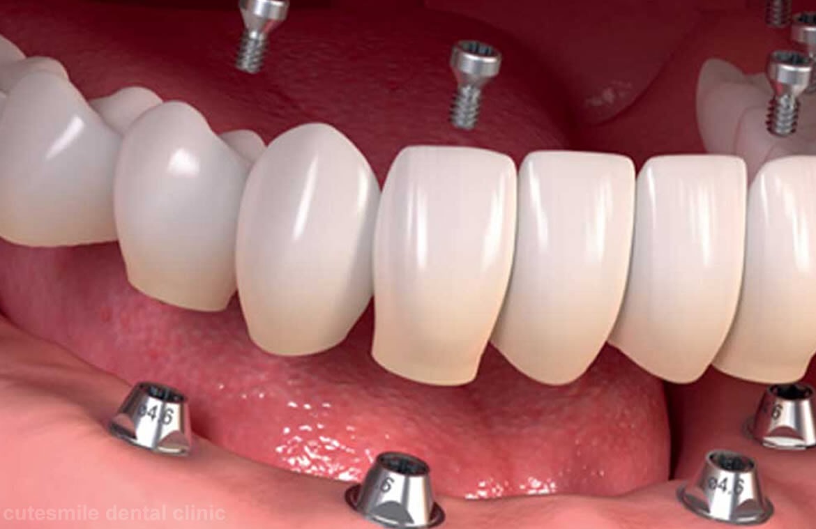 The Longevity and Maintenance of Dental Implants in Dubai