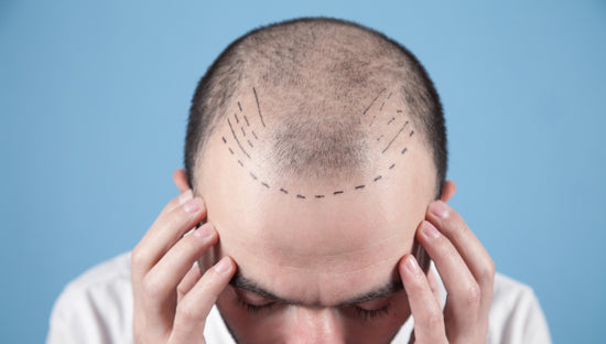 Innovations in FUE Hair Transplant Technology in Dubai