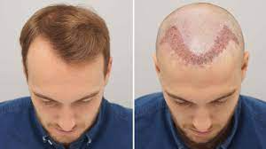 Hair Transplant Cost vs. Hair Loss Treatment: What’s Better?