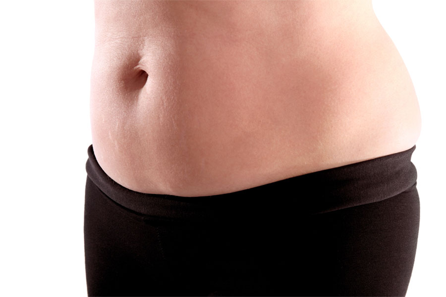 Cost-Saving Tips for Laser Liposuction in Dubai