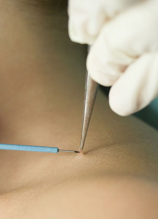 Costs of Skin Tag Removal in Dubai: What to Expect