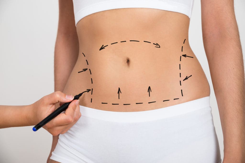 Tummy Tuck Dubai: Your Path to a Confident You