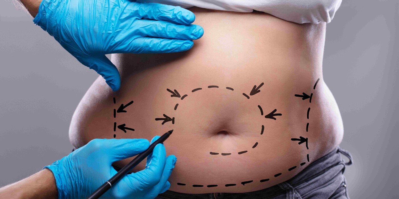 What to Expect Before, During, and After Tummy Tuck in Dubai?