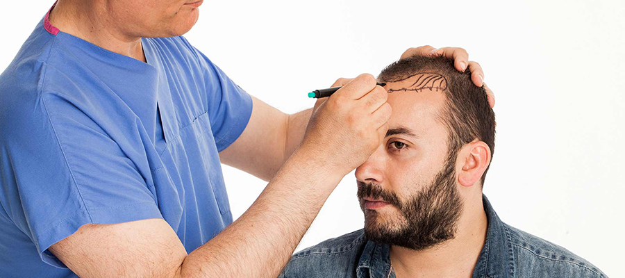 Embrace a New You with FUE Hair Transplants